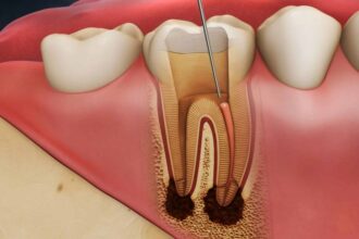 How Does Root Canal Restoration Treatment Progress from Consultation to Completion in Rolla