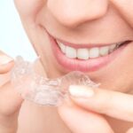What Really Happens During the Process of Clear Braces in Kelowna