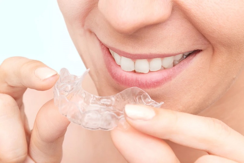 What Really Happens During the Process of Clear Braces in Kelowna