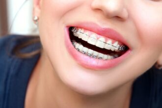 Straighten Your Smile With Clear Braces In Selkirk