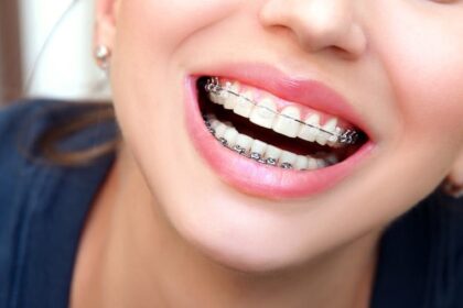 Straighten Your Smile With Clear Braces In Selkirk