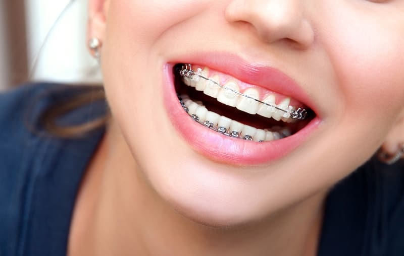 Straighten Your Smile With Clear Braces In Selkirk 1 Straighten Your Smile With Clear Braces In Selkirk