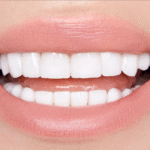 The Complete Guide to Getting Veneers for a Radiant Smile in Edison