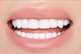 The Complete Guide to Getting Veneers for a Radiant Smile in Edison