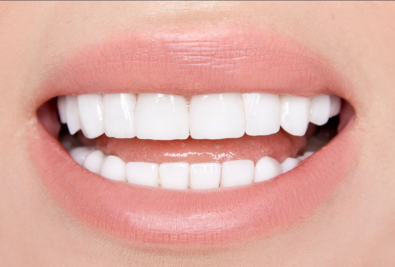The Complete Guide to Getting Veneers for a Radiant Smile in Edison