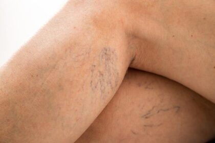 Safe Spider Vein Treatments To Reduce Visible Veins