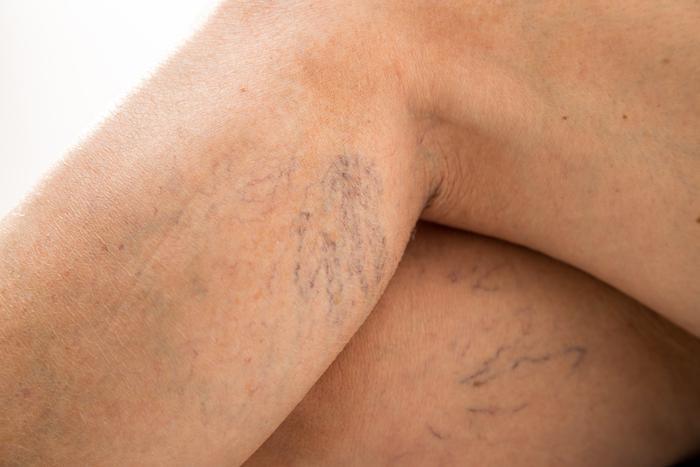Safe Spider Vein Treatments To Reduce Visible Veins
