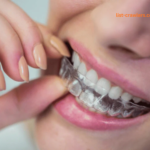 Step-by-Step Journey of Clear Aligner Care Treatment in Kelowna